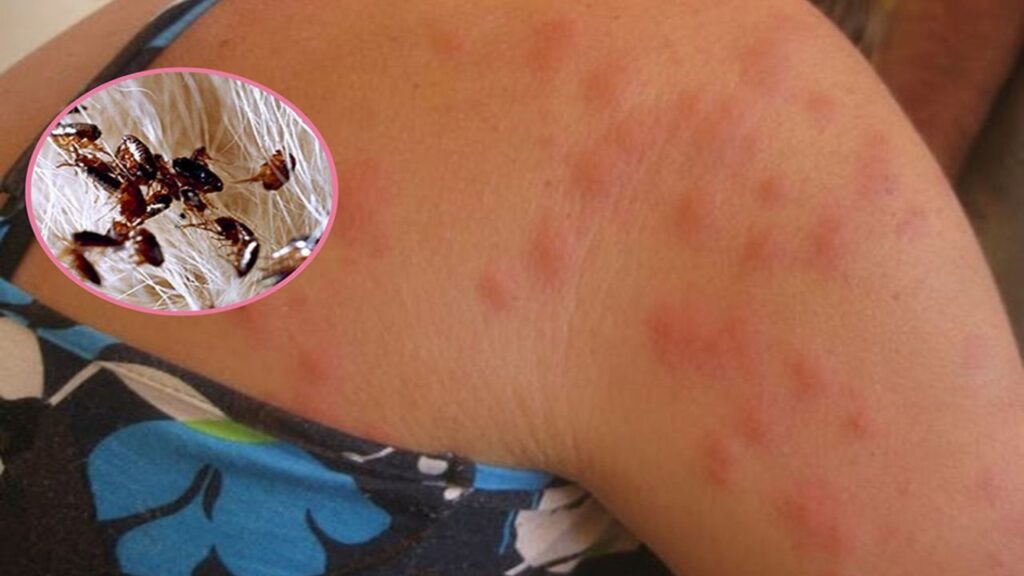 كيف تتخلص من البراغيث في المنزل بشكل دائم؟